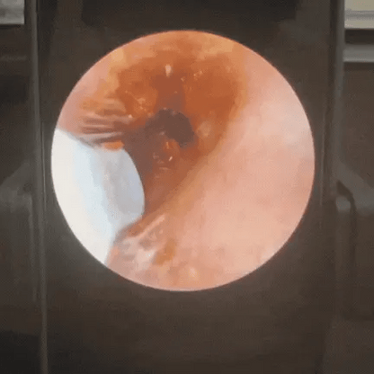 OTOSCOPE EARO – HYGIÈNE AUDITIVE RÉVOLUTIONNÉE