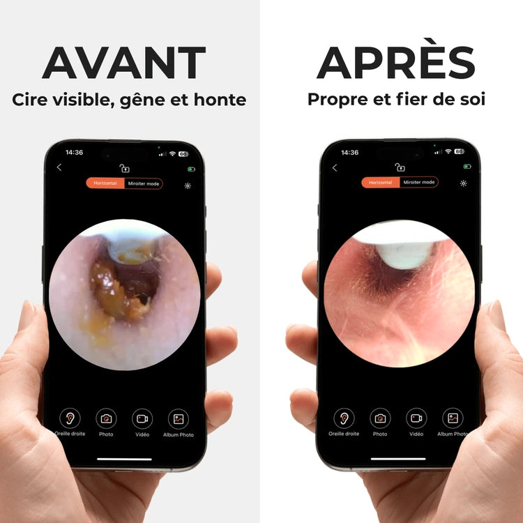 OTOSCOPE EARO – HYGIÈNE AUDITIVE RÉVOLUTIONNÉE
