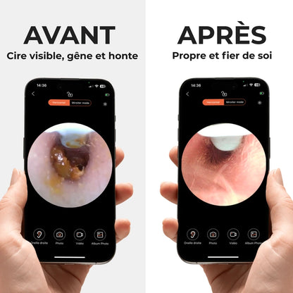 OTOSCOPE EARO – HYGIÈNE AUDITIVE RÉVOLUTIONNÉE